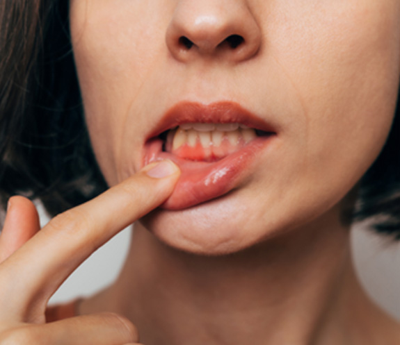 Woman with gum irritation