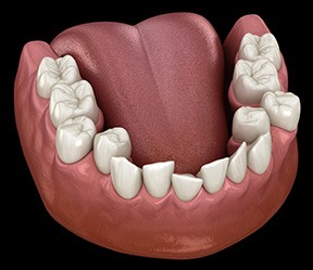 Illustration of crowded teeth