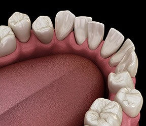 Illustration of gapped teeth