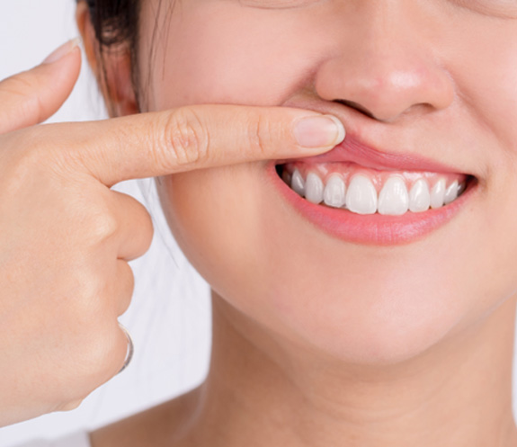 Woman pointing to her smile